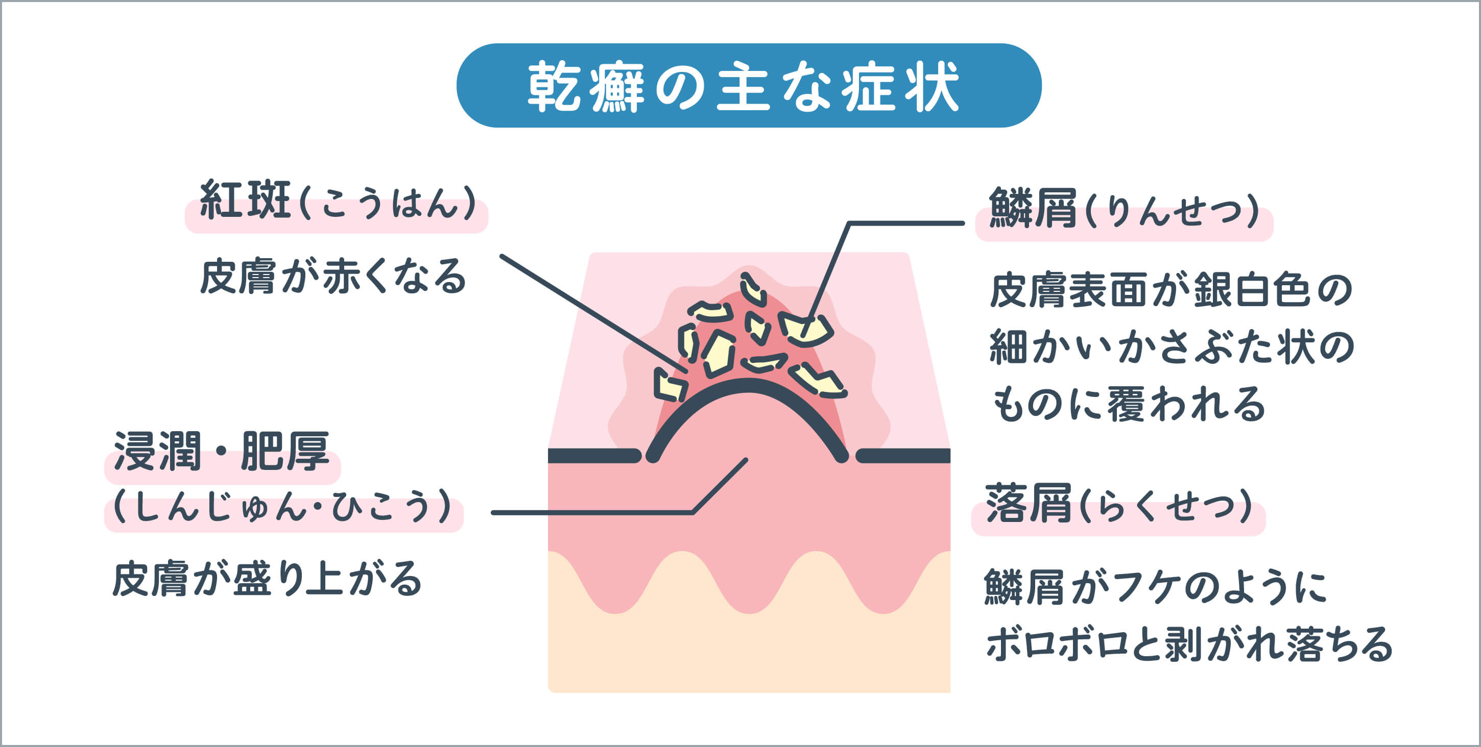 乾癬の主な症状