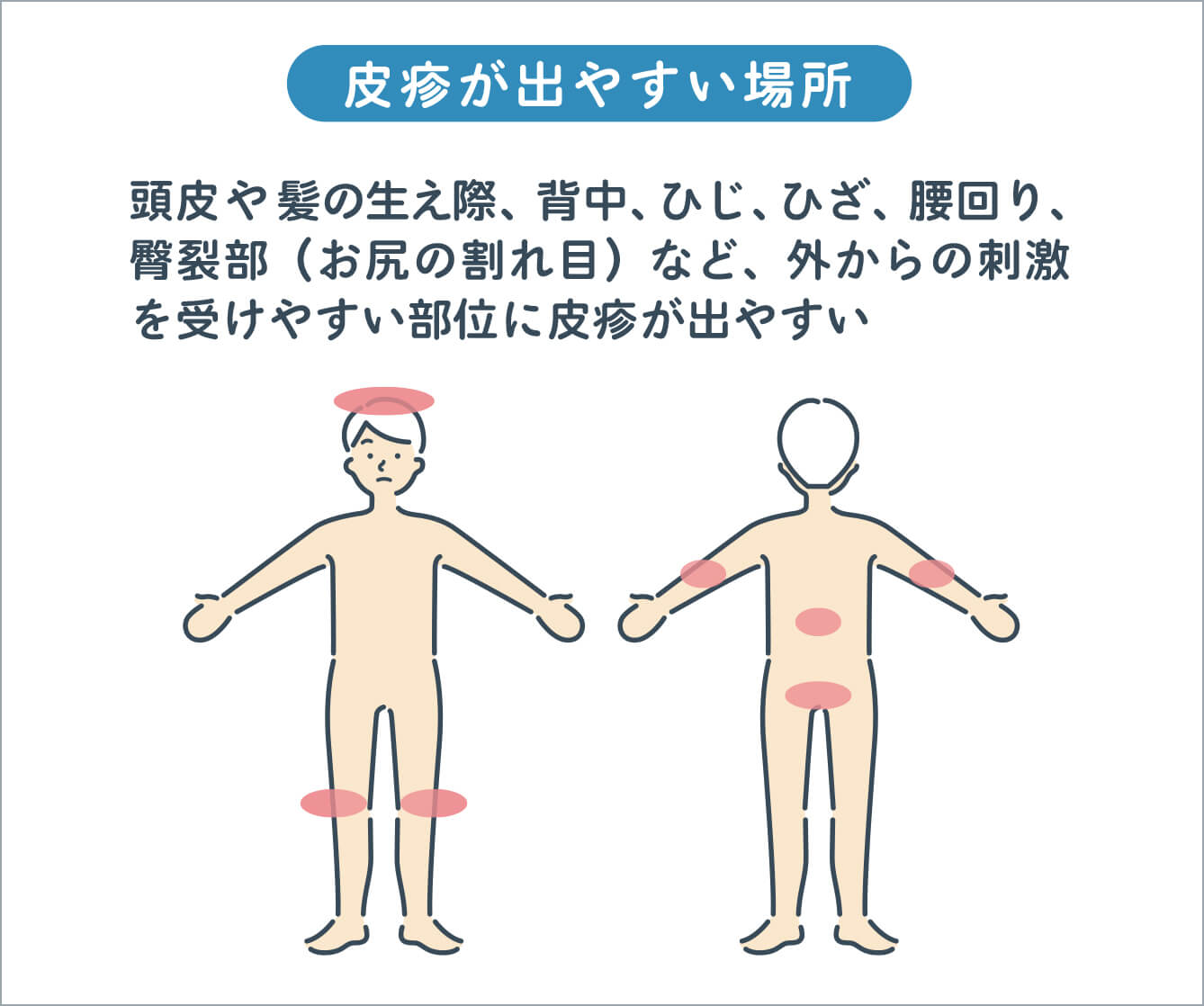 皮疹が出やすい場所