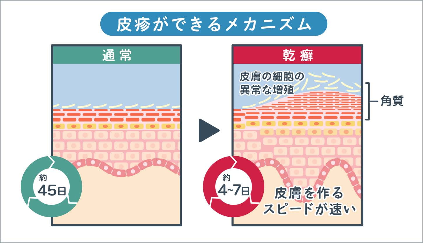 皮疹ができるメカニズム