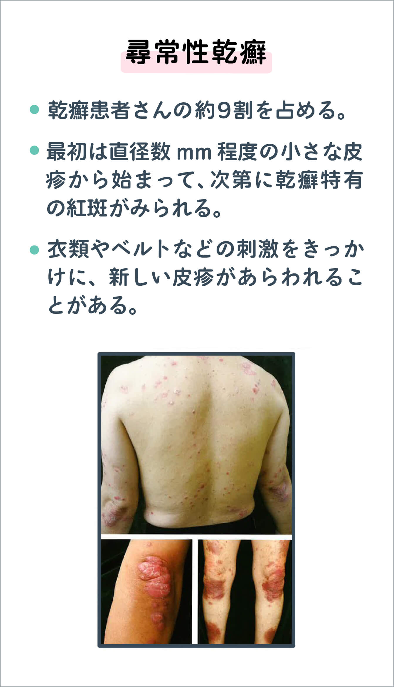 尋常性乾癬の写真