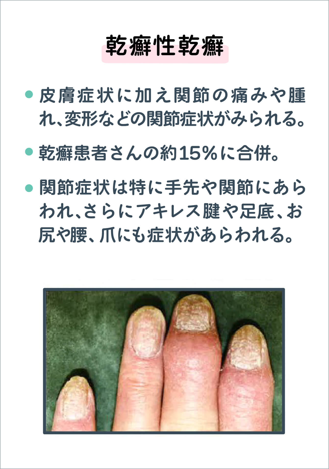 乾癬性関節炎の写真