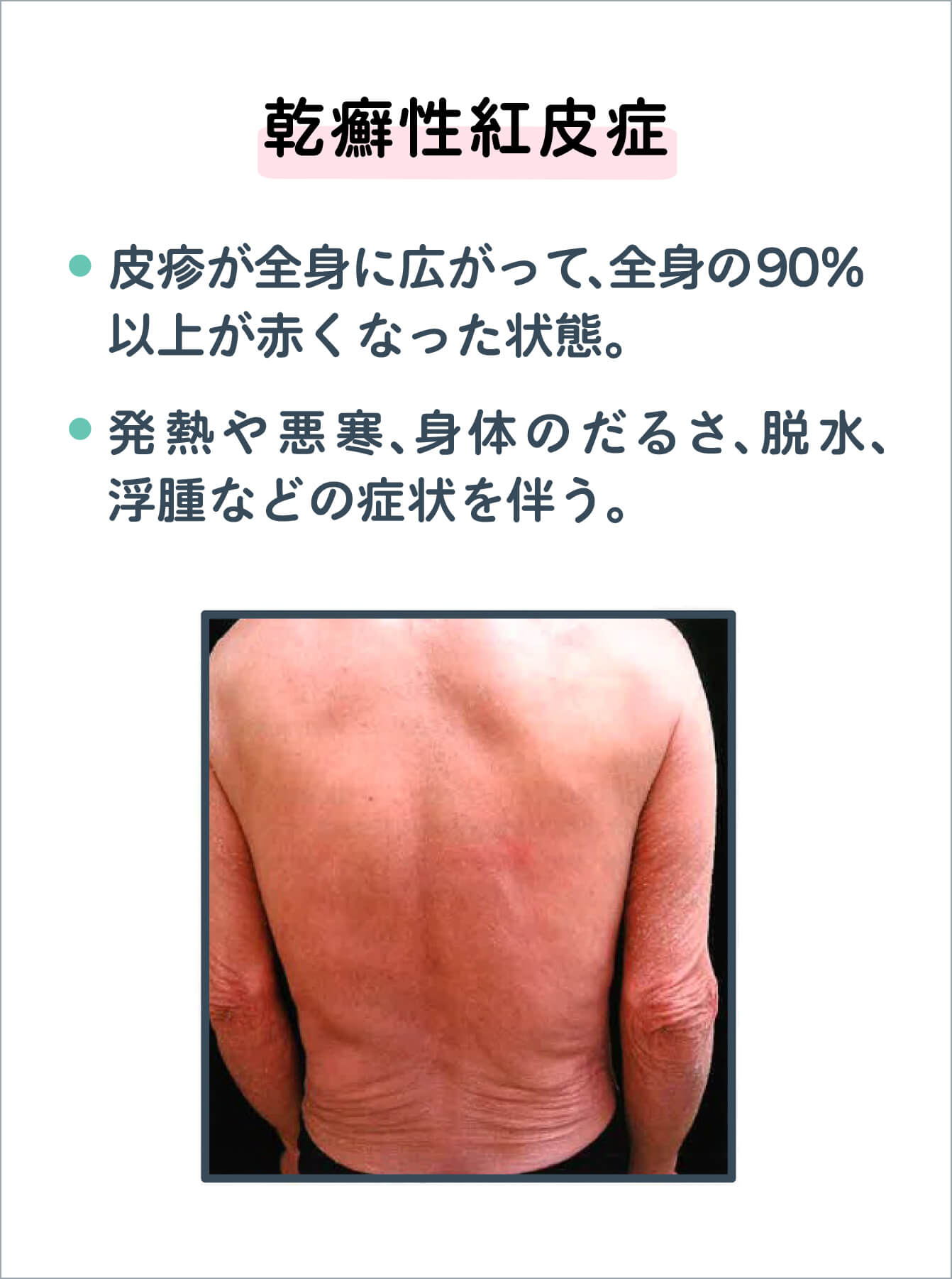 乾癬性紅皮症の写真