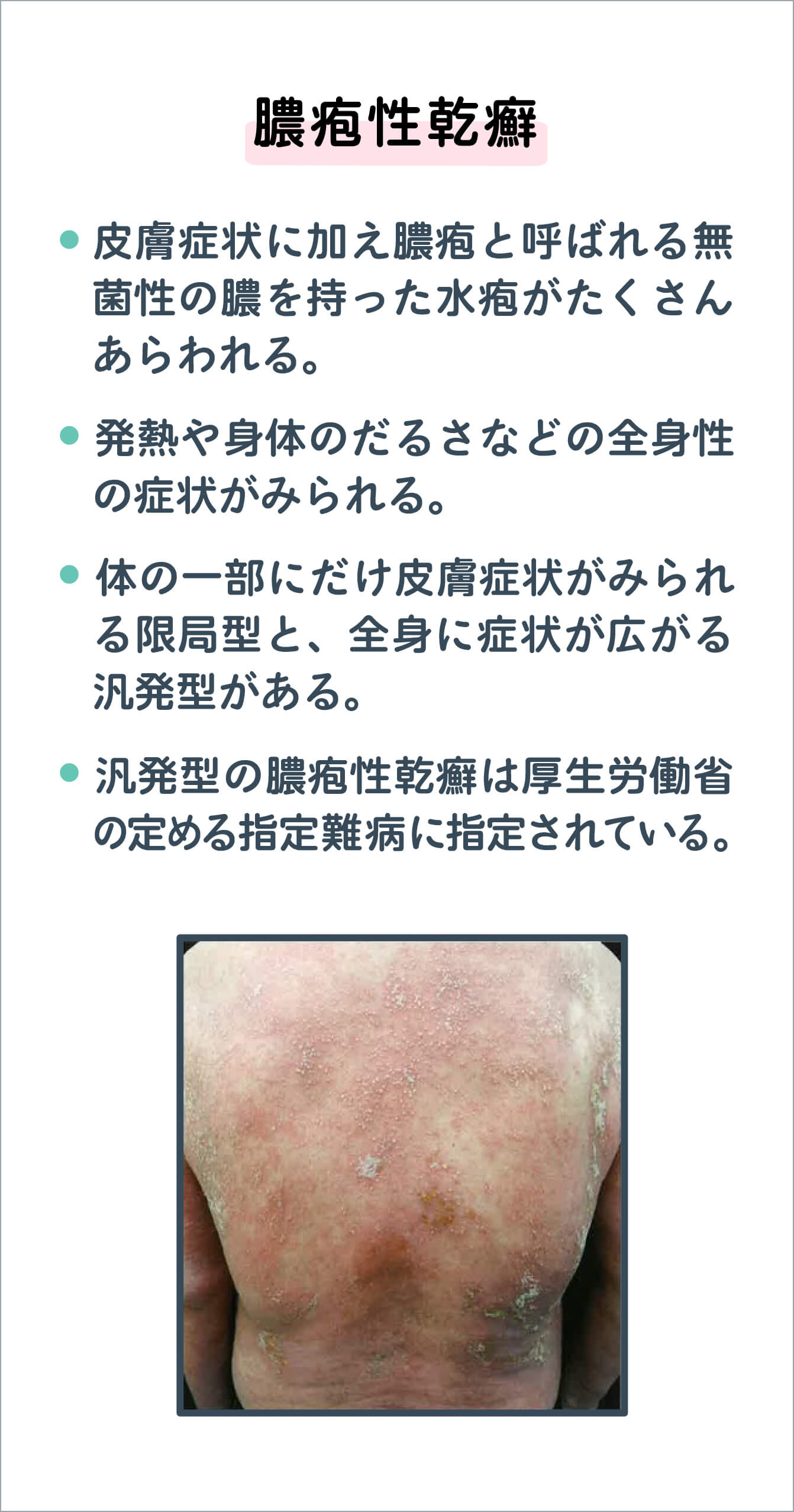 膿疱性乾癬の写真