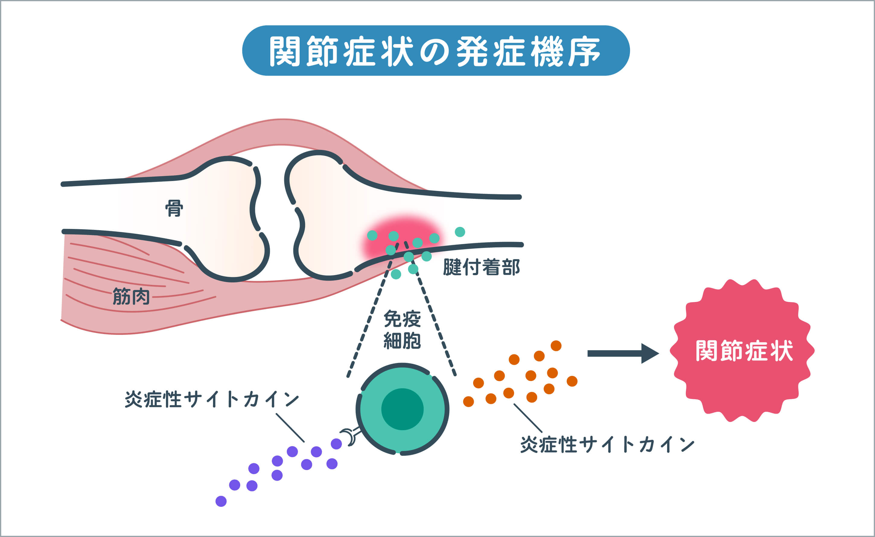 関節症状の発症機序